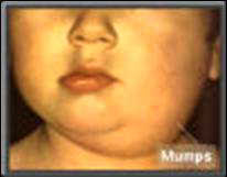 Mumps ist bei
                      Blutgruppe B besonders häufig