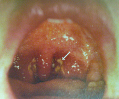 Mononukleosis aparece m�s con el grupo
                      sangu�neo 0.