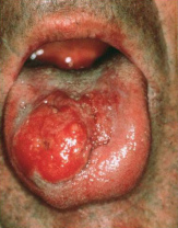 Krebs (hier ein Zungenkrebs) ist
                          blutgruppenspezifisch und ist entsprechend
                          verschieden heilbar