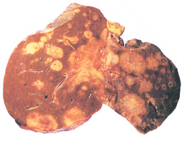 C�ncer de h�gado