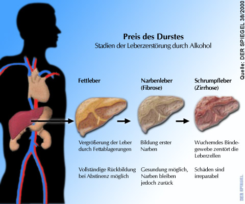 Grafik:
                    Fettleber - Narbenleber - Schrumpfleber durch
                    Alkohol