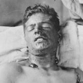 Senfgas ver�tzt Gesicht, Erster
                        Weltkrieg