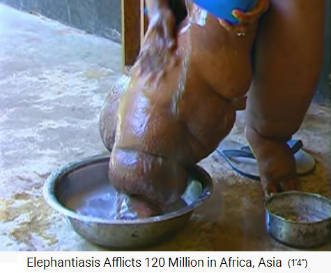 Afrika: Elephantiasis an beiden Beinen