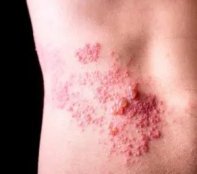 G�rtelrose am
                R�cken 03