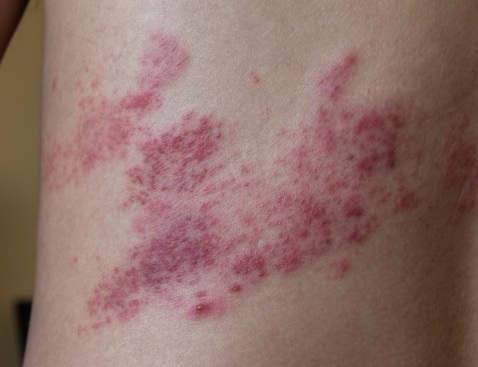 G�rtelrose am
                R�cken 02 Zoom