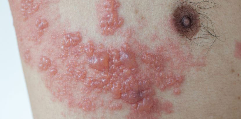 G�rtelrose mit Bl�schen im Brustbereich, die
                Fl�ssigkeit in den Bl�schen ist ansteckend