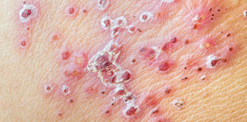 Dr. Herold in
                �sterreich: G�rtelrose beim Abheilen mit Krustenbildung