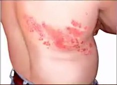 G�rtelrose am R�cken