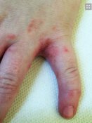 Kr�tze
                              an einer Hand