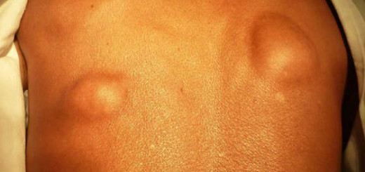 Lipoma
                                    on a back are healing with baking
                                    soda (sodium bicarbonate) in water
                                    with sugar molasses / maple syrup