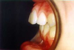 Protrusi�n o sobre
                        mordida horizontal o dientes superiores salidos:
                        La mand�bula no es bien formada, el maxilar
                        superior es mucho m�s grande que la mand�bula
                        [32]