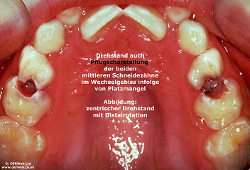 Cuando los dos
                        dientes incisivos frontales no tienen bastante
                        despacio, as� salen muchas veces en una
                        "posici�n girada c�ntrica", la
                        posici�n llamada "posici�n de reja".
                        Adem�s se ve en la foto muchas manchas blancas,
                        precursores de caries, y grandes caries entre
                        los dos premolares [13].