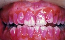 Aqu� se ve un
                        segundo diente incisivo arriba al lado izquierdo
                        en una posici�n girada "saliendo el arco
                        dental".