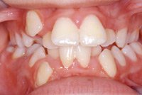 Apinamiento de los
                        dientes, una vista frontal: Un apinamiento de
                        los dientes va ser cuando el bebe solo recibe su
                        alimentaci�n por el biber�n y as� fue siempre
                        f�cil a chupar. As� eso no provoca un grande
                        crecimiento del maxilar. M�s tarde los dientes
                        no tienen bastante espacio [2] y la dentadura
                        parece a cereales [8].