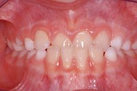 Con la mordida
                        cruzada frontal los dientes incisivos inferiores
                        est�n antes de los dientes incisivos superiores