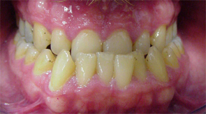 Posici�n mesial: La
                        mand�bula es mucho m�s grande que el maxilar
                        superior
