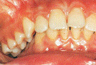 Con esa nonoclusi�n
                        una hila dental completa est� "al
                        lado"