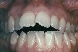 Por
                        chupar demasiado el dedo o chupar al biber�n o
                        al chupete de tranquilizaci�n se forma la
                        malformaci�n dentaria de la "mordida
                        abierta" con los dientes permanentes [5].