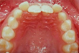 En esa foto se ve los primeros
                dientes incisivos como dientes de hoz, dientes
                "inclinados", "doblados".
