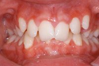 Malformaci�n dentaria Mordida cerrada
                          anterior (sobre mordida vertical profunda)