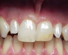 Dientes espigas son dientes que - por
                            raz�n gen�tico - tienen una corona dental
                            reducida y tienen una forma de tronco, como
                            aqu� los segundos dientes incisivos en la
                            foto.