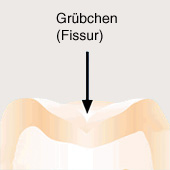 Jeder Backenzahn (Molar und Prmolar) hat
                          jeweils ein Grbchen (Fissur), die so genannte
                          Zahnfurche (hier ein Schema im Querschnitt)