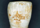 Zahn mit Fluorose durch massive
                          berdosierung von Fluor