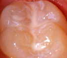 Ein
                        Mahlzahn mit versiegelten Grbchen
                        ("Fissuren"), mit Grbchenversiegelung
                        / Fissurenversiegelung