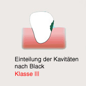 Karies-Kavitt gemss Black, Klasse 3