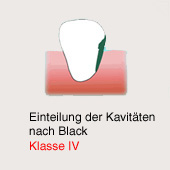 Karies-Kavitt gemss Black, Klasse 4
