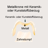 Krone: Metallkeramikkrone: Metallkrone
                          auf dem Zahnstumpf mit Keramik- oder
                          Kunststoffberzug [29]