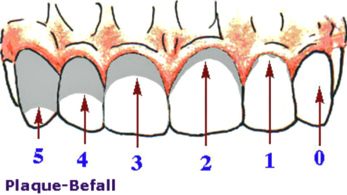 Zahnbelag (Plaque), Schema: Die Zahnrzte
                          teilen die Plaque an Zhnen verschieden ein,
                          je nach Plaque-Befall des Zahns zwischen 0
                          Plaque (Nr. 0) und ber 2/3 Plaque (Nr. 5)
                          [15].