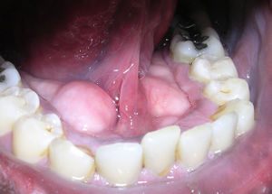 Gelber Zahnbelag
                        (Plaque), hier vor allem in den
                        Zahnzwischenrumen, aber auch in Zahnfurchen gut
                        zu sehen