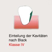 Karies-Kavit�t gem�ss Black, Klasse 4