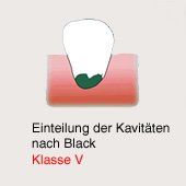 Karies-Kavit�t gem�ss Black, Klasse 5