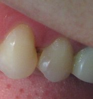 Die rotbraune Karies zwischen den
                                  Z�hnen greift zwei Z�hne gleichzeitig
                                  an. So passiert das, wenn man keine
                                  Ahnung hat und auf die Pr�vention mit
                                  Zahnseide oder Dentalhygienikerin
                                  verzichtet, hier sichtbar an einer
                                  Zahnpatientin aus Peru (2009).