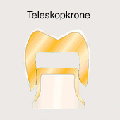 Krone: Die Teleskopkrone ist die
                              Krone f�r den Backenzahn oder Mahlzahn,
                              mit einem unteren und einem oberen Teil
                              ("Doppelkrone") [35].