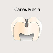 Mittlere Karies (caries media), Schema,
                          die Behandlung (das Ausbohren der
                          Kariesstelle) ist schmerzlos [4]