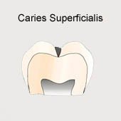 Oberfl�chenkaries (caries superficialis),
                          Schema, die Behandlung (das Ausbohren der
                          Kariesstelle) ist schmerzlos [4]