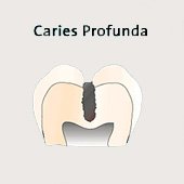 Tiefe Karies (caries profunda), Schema,
                          die Karies ist nahe am Zahnmark, das sich in
                          der Zahnmarkh�hle befindet (allgemein als
                          "Nerv" bezeichnet), und die
                          Behandlung (das Ausbohren der tiefen
                          Kariesstelle) ist mit Schmerzen verbunden,
                          eventuell ist das Zahnmark ("Nerv")
                          auch schon mit Karies infiziert [4]