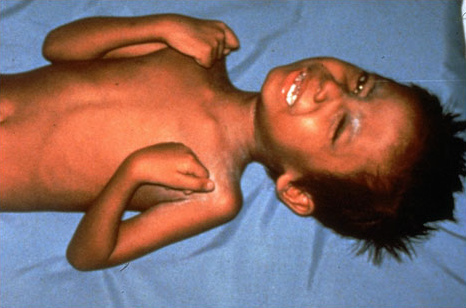 Kind mit Tetanus-Muskelkrämpfen, Foto
                  der Impf-WHO