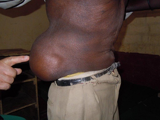 Leistenbruch (Bauchhernie) im Sudan bei
                  einem Mann