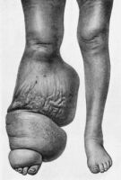 Elephantiasis-Geschw�r am Bein