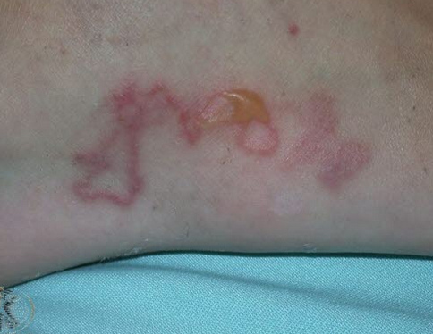 Hakenwurmkrankheit (Ankylostomiasis)