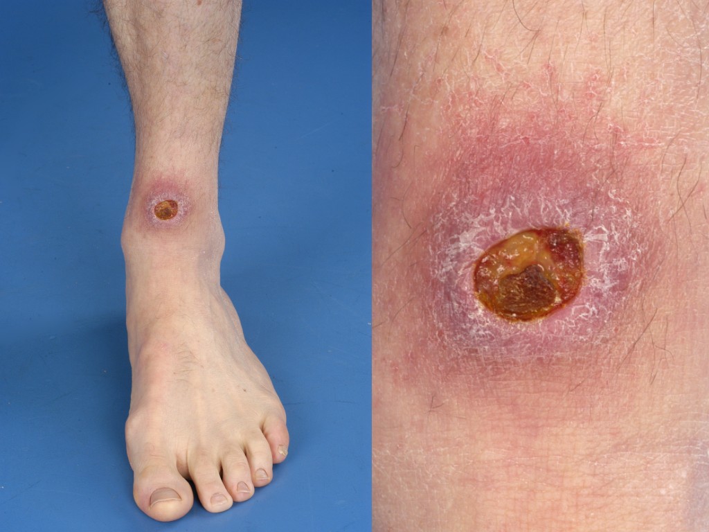 Buruli
                  ulcer in Africa + Asia