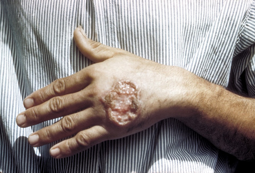 Leishmaniasis ulcer Leishmaniasis ulcer
