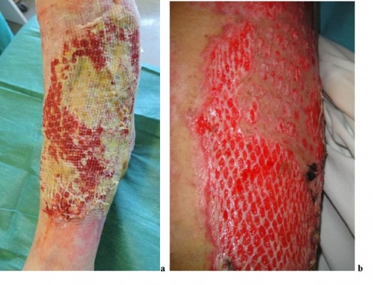 Skin transplants on the lower leg Skin
transplants on the lower leg