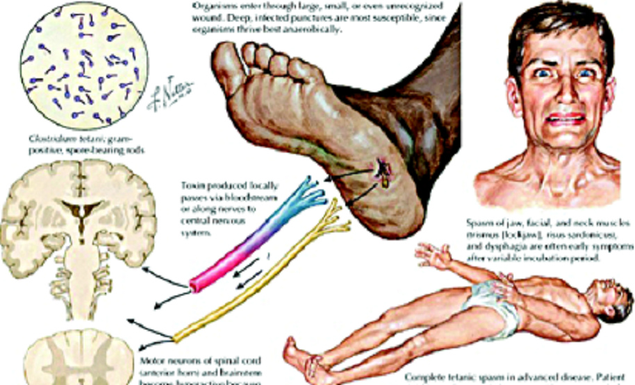 Kreislauf bei Tetanus, Schema (englisch)