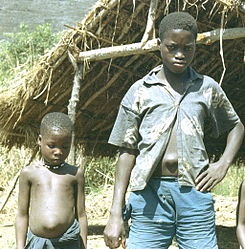 Umbilical hernia in Africa in a child