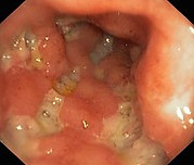 Morbus Crohn
                Darmentzndung